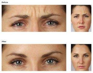 Botox before & after